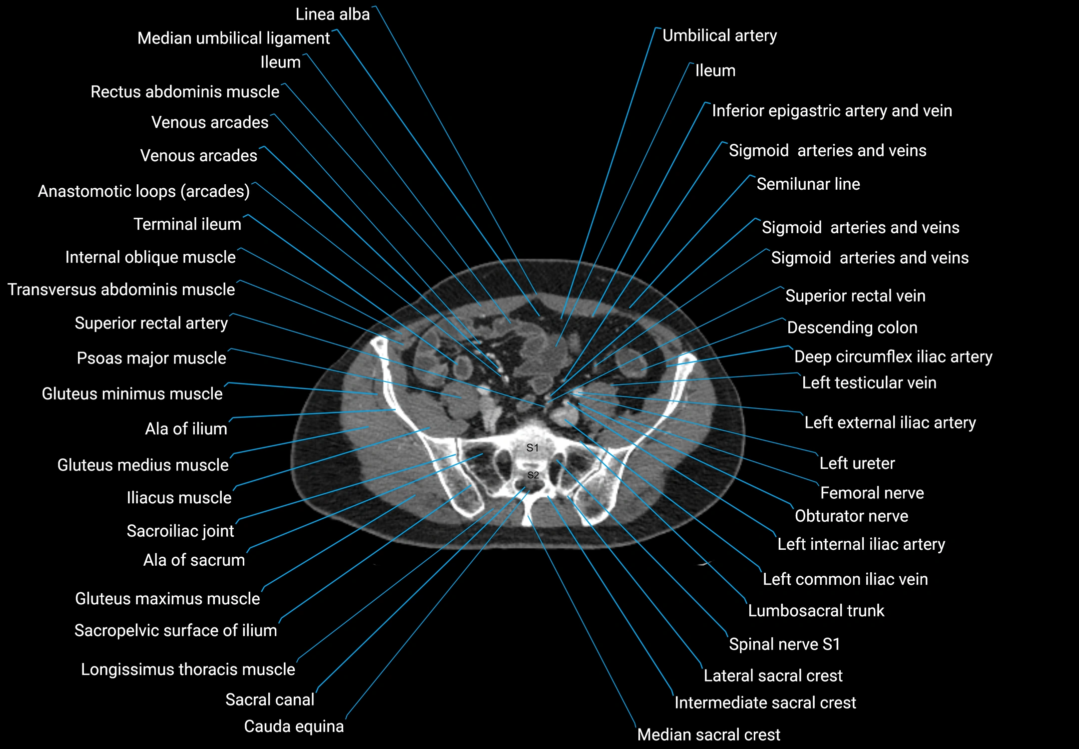 CT male pelvis axial cross sectional anatomy labelled radiology image -00145.webp